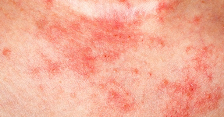 ۶ راهکار ساده برای درمان اگزما پوستی