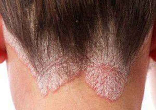 علل خارش پوست چیست و چگونه درمان میشود؟