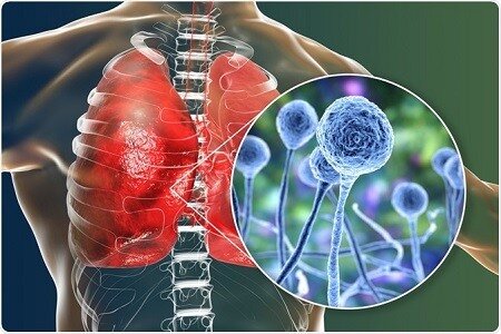 قارچ سیاه با کووید ۱۹ چه ارتباطی دارد؟