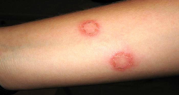 بیماری سالک چیست؟؛ علائم، درمان و پیشگیری