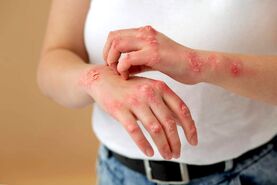 اگزما چیست؟ | علل، علائم، انواع، درمان و پیشگیری + تصاویر اگزما