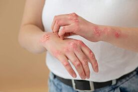 اگزما چیست؟ | علل، علائم، انواع، درمان و پیشگیری + تصاویر اگزما