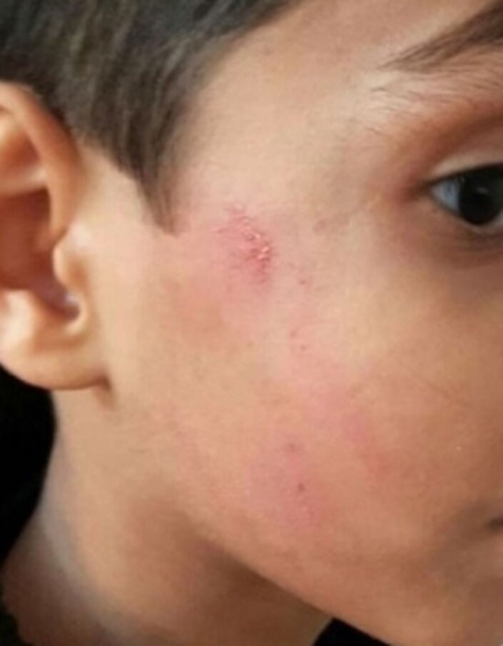 ردِ انگشتر مدیر روی صورت دانش‌آموز بعد از ۲۰ روز!