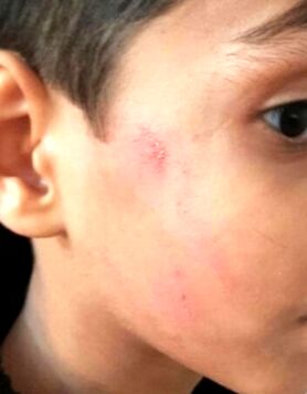 ردِ انگشتر مدیر روی صورت دانش‌آموز بعد از ۲۰ روز!