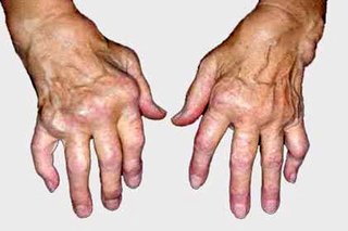 زنان قربانیان اصلی بیماری روماتیسم