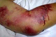 شناسایی یک مورد مشکوک به بیماری تب کنگو در شاهین‌شهر