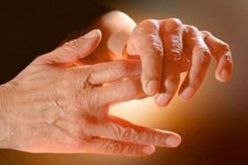 دیابت ، شایع‌ترین علت سوزش دست و پا