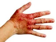 اگزما با بیماری‌های قلبی مرتبط نیست