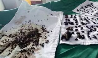 خارج کردن 200سنگ صفرا از بدن زن چینی