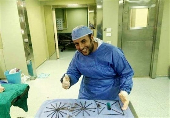 خارج شدن ۳۹ میخ فندک و قیچی از معده یک بیمار