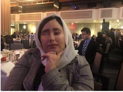 قربانی اسیدپاشی مهمان ضیافت شام رییس‌جمهور