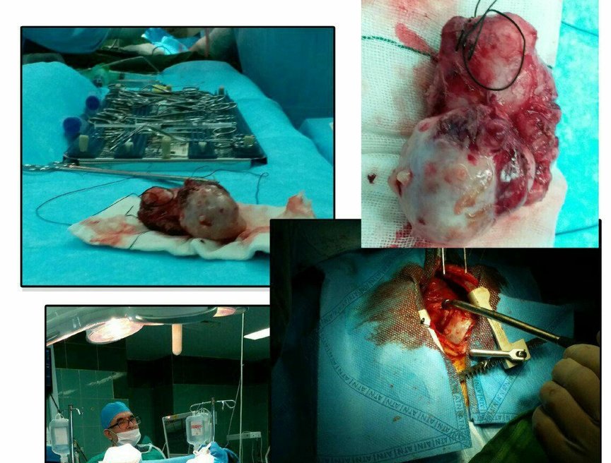 خروج تومور ۱۲سانتی از قلب کودک شیرخوار