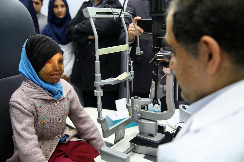 وزیر بهداشت، دختر قربانی اسیدپاشی را معاینه کرد