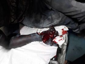 قطع دست نوجوان 16 ساله افغانی بر اثر  انفجار مواد محترقه