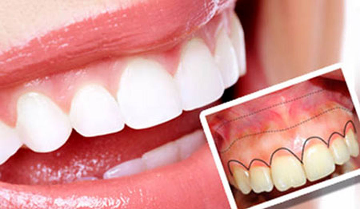 راههای جلوگیری از تحلیل رفتن لثه