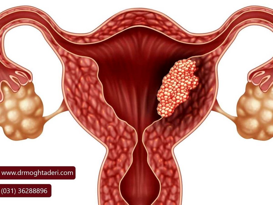 پیشگیری از سرطان دهانه رحم