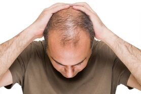 چگونه از ریزش مو جلوگیری کنیم؟