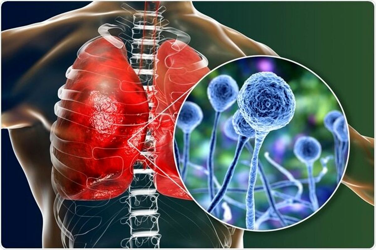 قارچ سیاه چیست؟ + تشخیص، عوارض و درمان موکورمایکوزیس و کرونا