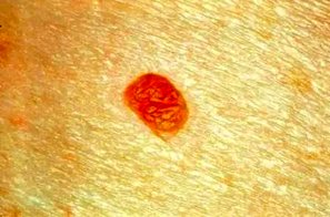 زخم و لکه های قرمز از علائم سرطان پوست است