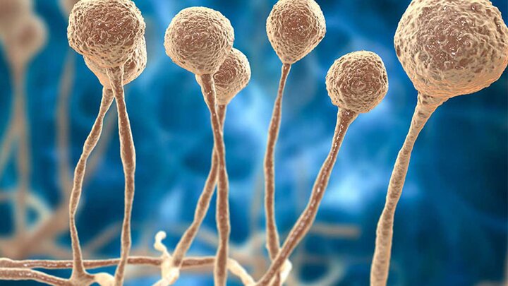 قارچ سیاه، دستیار مرگبار کرونا در موج دلتا