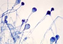 علائم، عوارض و درمان بیماری قارچ سیاه