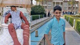 آخرین وضعیت نوجوان ایذه‌ای از زبان رئیس بیمارستان سوانح سوختگی اصفهان