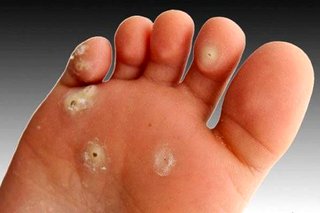 دلیل ایجاد میخچه چیست؟ + درمان خانگی
