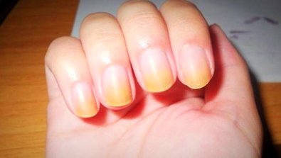 چگونه زردی ناخن را از بین ببریم و درمان کنیم؟