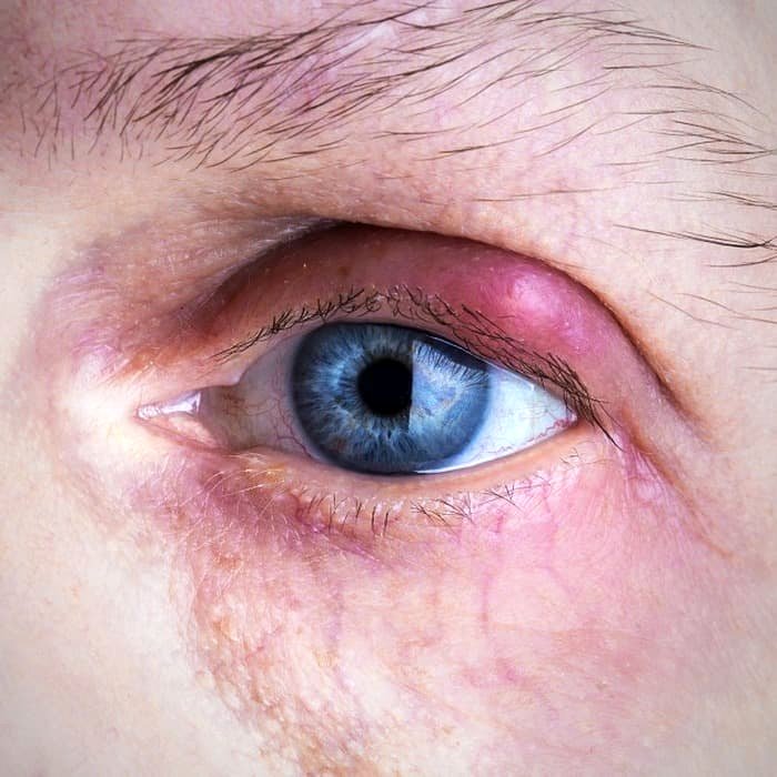 تمام علل و راه های درمان خانگی گل مژه