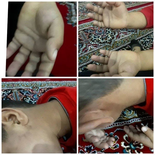 شکنجه دانش آموز کلاس اول توسط معلم / یک هفته است ابوالفضل شب‌ها با وحشت از خواب می‌پرد