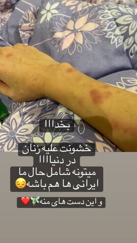 “نفیسه روشن” مورد ضرب و شتم و خشونت خانگی قرار گرفت! + عکس دست کبود وی