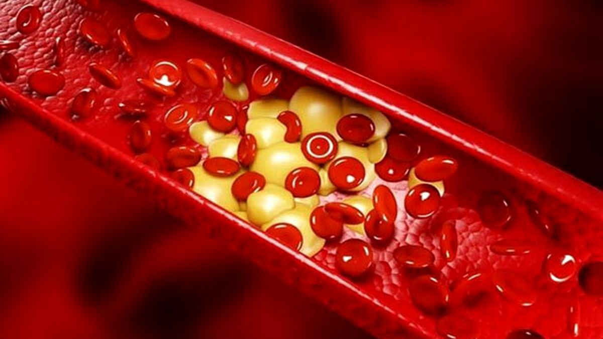 روش‌های درمان چربی خون + فیلم