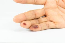 علت بروز زگیل و درمان آن
