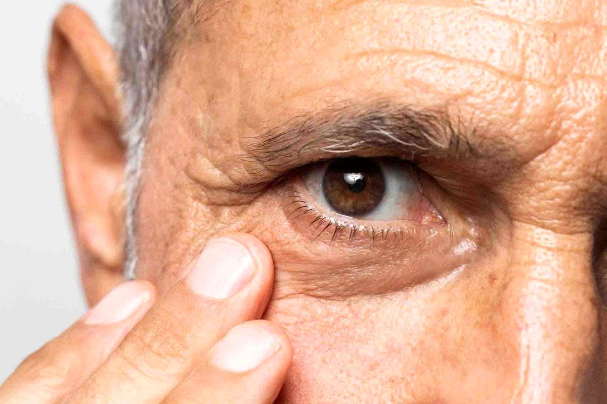 پیرچشمی چیست و چگونه درمان می‌شود؟ | علائم، علل و راهکارهای مؤثر