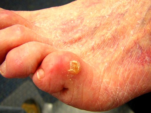 سیر و سرکه و آبلیمو دشمن میخچه هستند