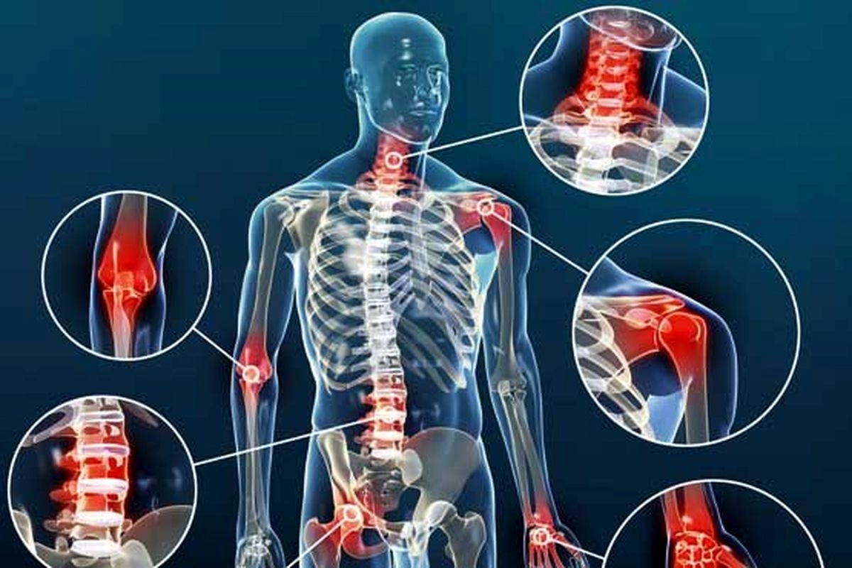 آرتروز چیست؟ | علائم، علل، درمان و روش‌های پیشگیری