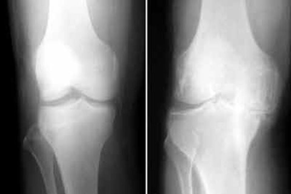 کاهش فاصله مفصلی؛ نخستین نشانه ساییدگی زانو