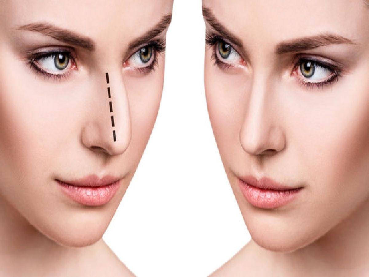 چند نوع عمل زیبایی بینی داریم؟